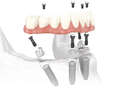 Dental Implant Image